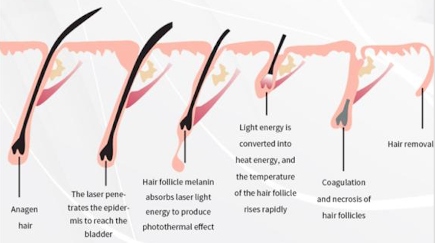 MBT Laser Triple wavelength hair removal laser High power-Esthetician